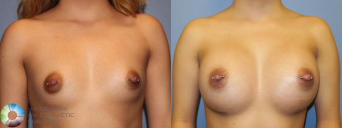 Before & After Breast Augmentation Case 965 View #1 View in Golden, CO