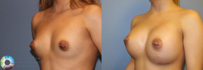 Before & After Breast Augmentation Case 965 View #2 View in Golden, CO