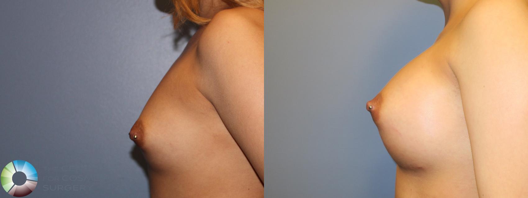 Before & After Breast Augmentation Case 965 View #3 in Denver and Colorado Springs, CO