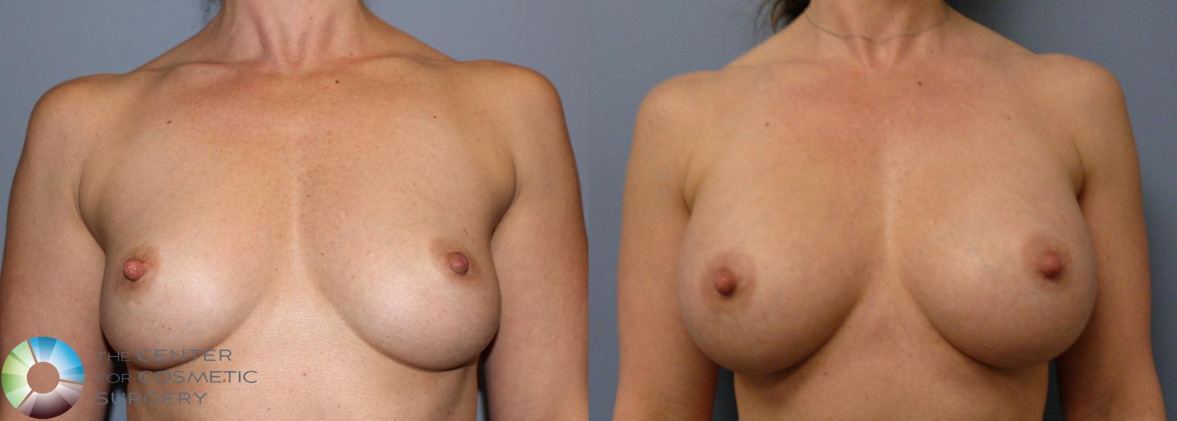 Before & After Breast Augmentation Case 966 View #1 in Denver and Colorado Springs, CO