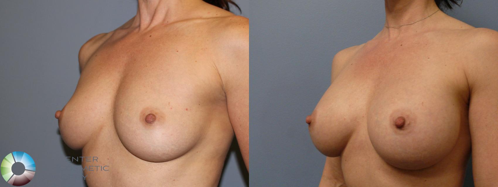 Before & After Breast Augmentation Case 966 View #2 View in Golden, CO