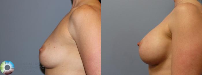 Before & After Breast Augmentation Case 966 View #3 View in Golden, CO