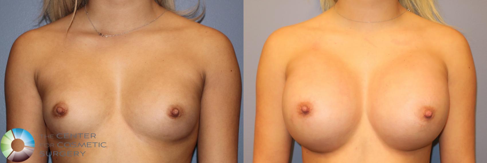 Before & After Breast Augmentation Case 974 View #1 in Denver and Colorado Springs, CO