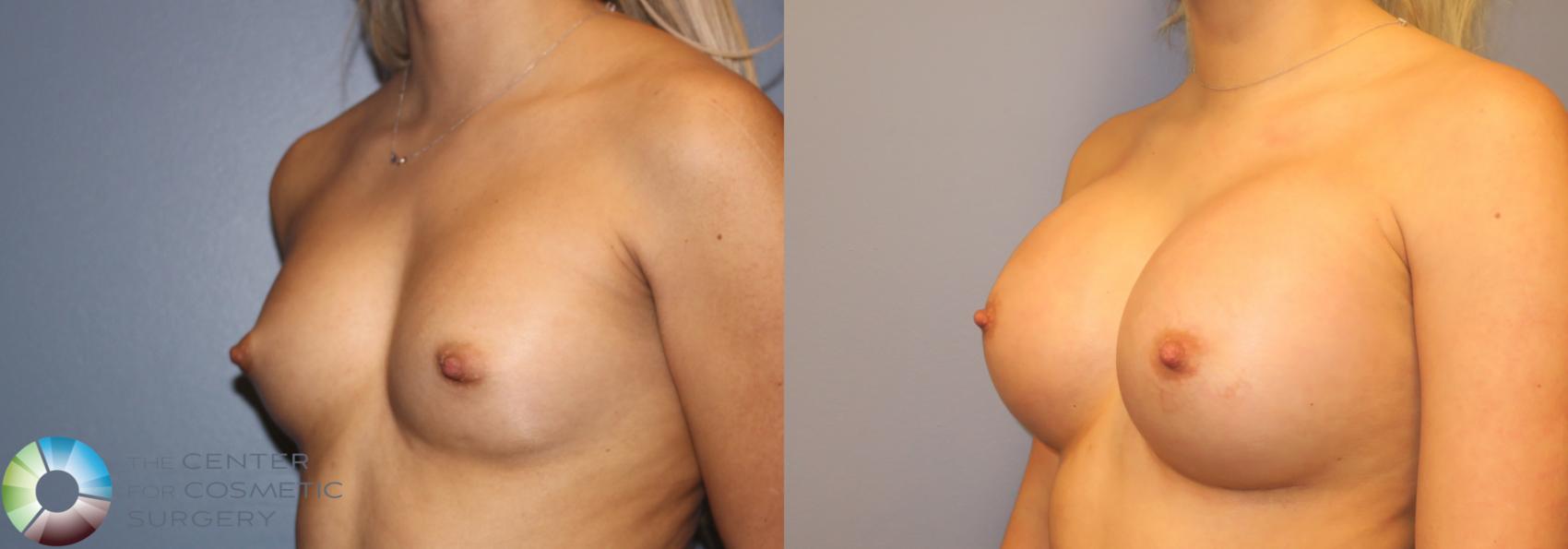 Before & After Breast Augmentation Case 974 View #2 View in Golden, CO