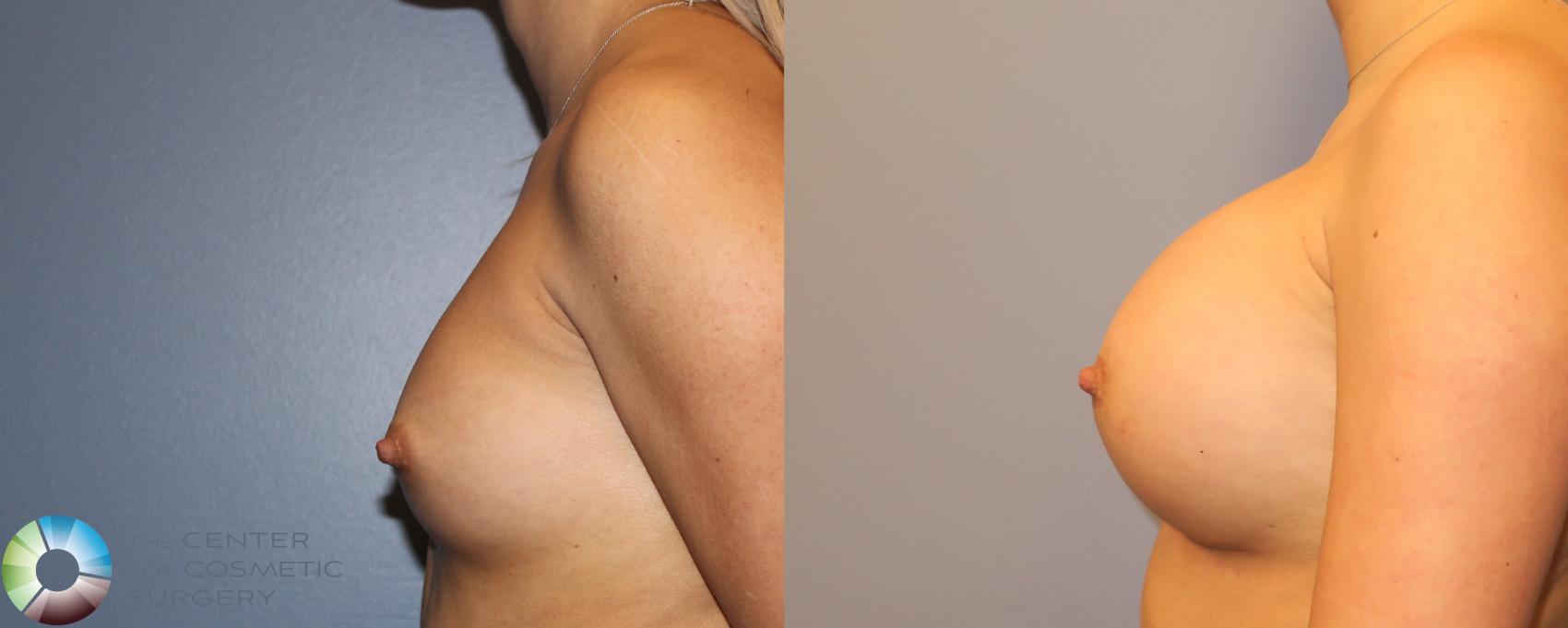 Before & After Breast Augmentation Case 974 View #3 View in Golden, CO