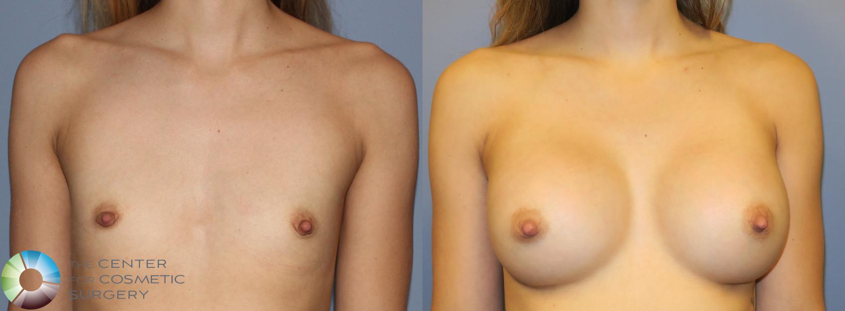 Before & After Breast Augmentation Case 976 View #1 in Denver and Colorado Springs, CO