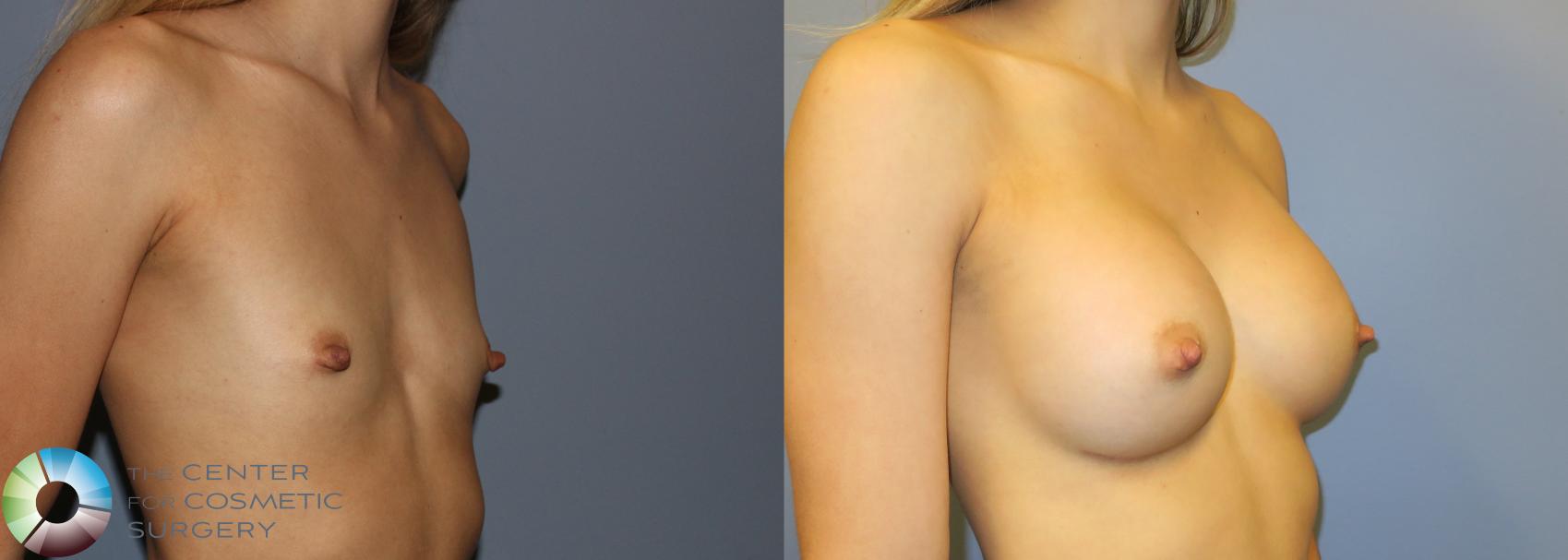 Before & After Breast Augmentation Case 976 View #2 in Denver and Colorado Springs, CO