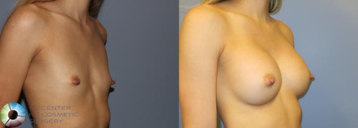 Before & After Breast Augmentation Case 976 View #2 View in Golden, CO