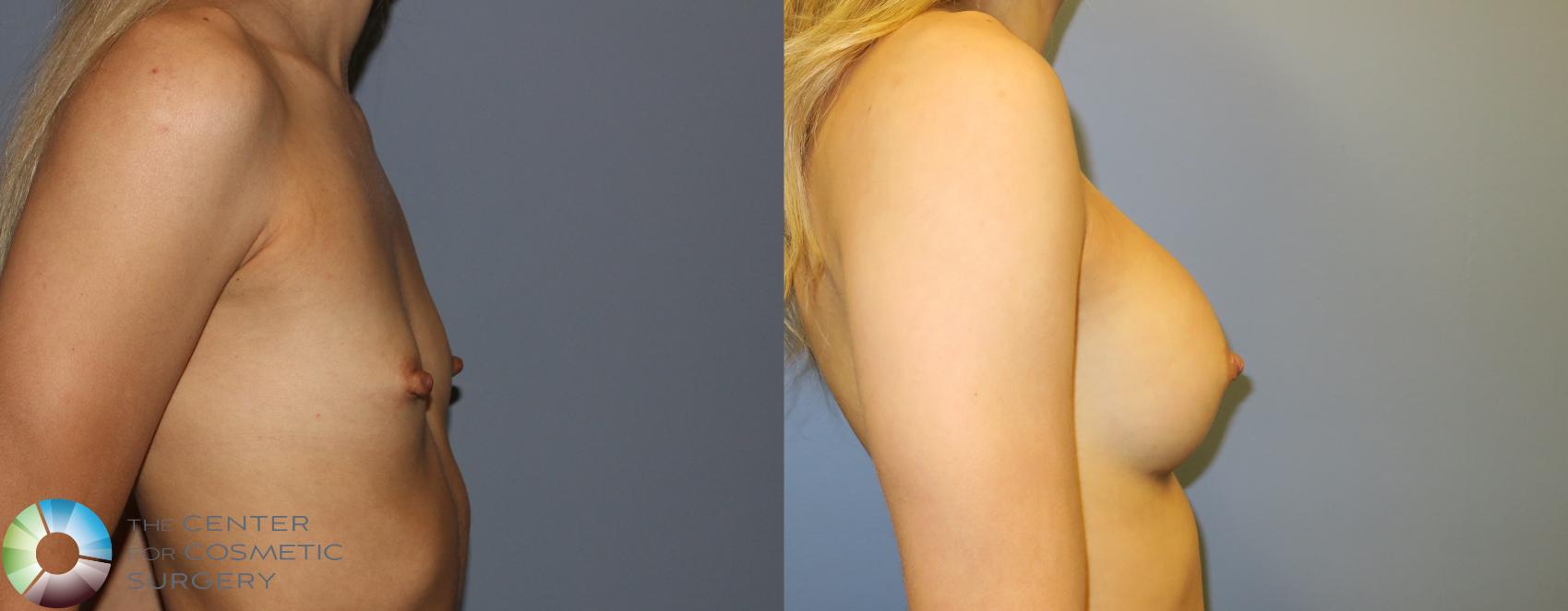 Before & After Breast Augmentation Case 976 View #3 in Denver and Colorado Springs, CO
