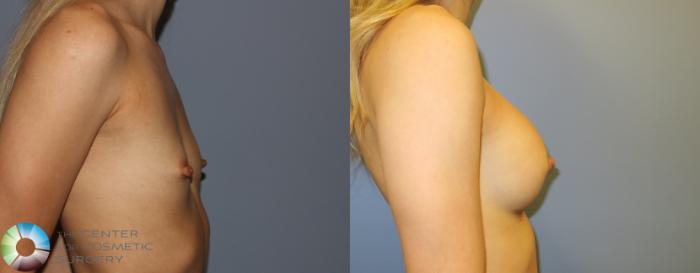 Before & After Breast Augmentation Case 976 View #3 View in Golden, CO