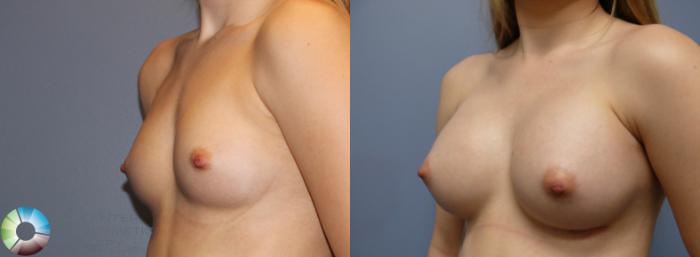 Before & After Breast Augmentation Case 980 View #1 in Denver and Colorado Springs, CO