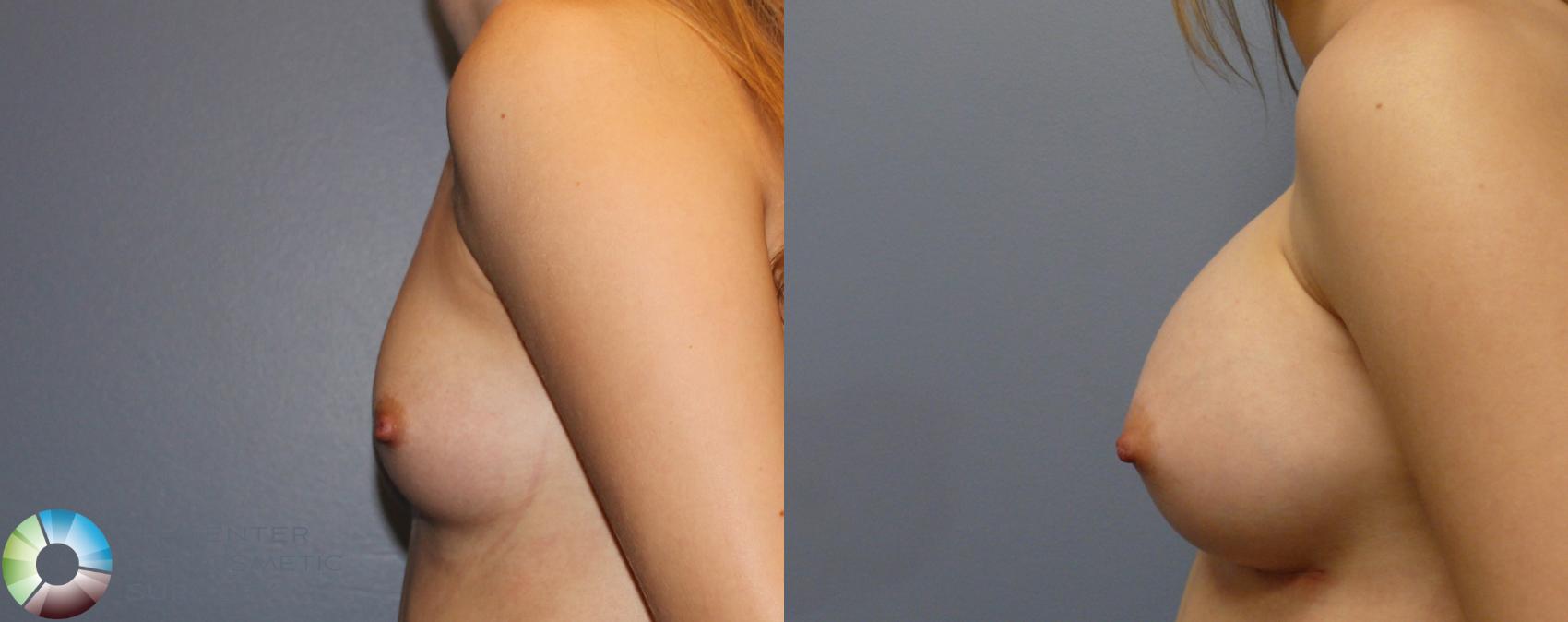 Before & After Breast Augmentation Case 980 View #2 View in Golden, CO