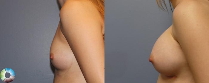 Before & After Breast Augmentation Case 980 View #2 in Denver and Colorado Springs, CO
