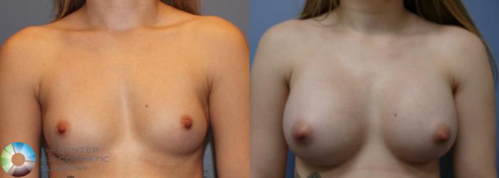Before & After Breast Augmentation Case 980 View #3 in Denver and Colorado Springs, CO
