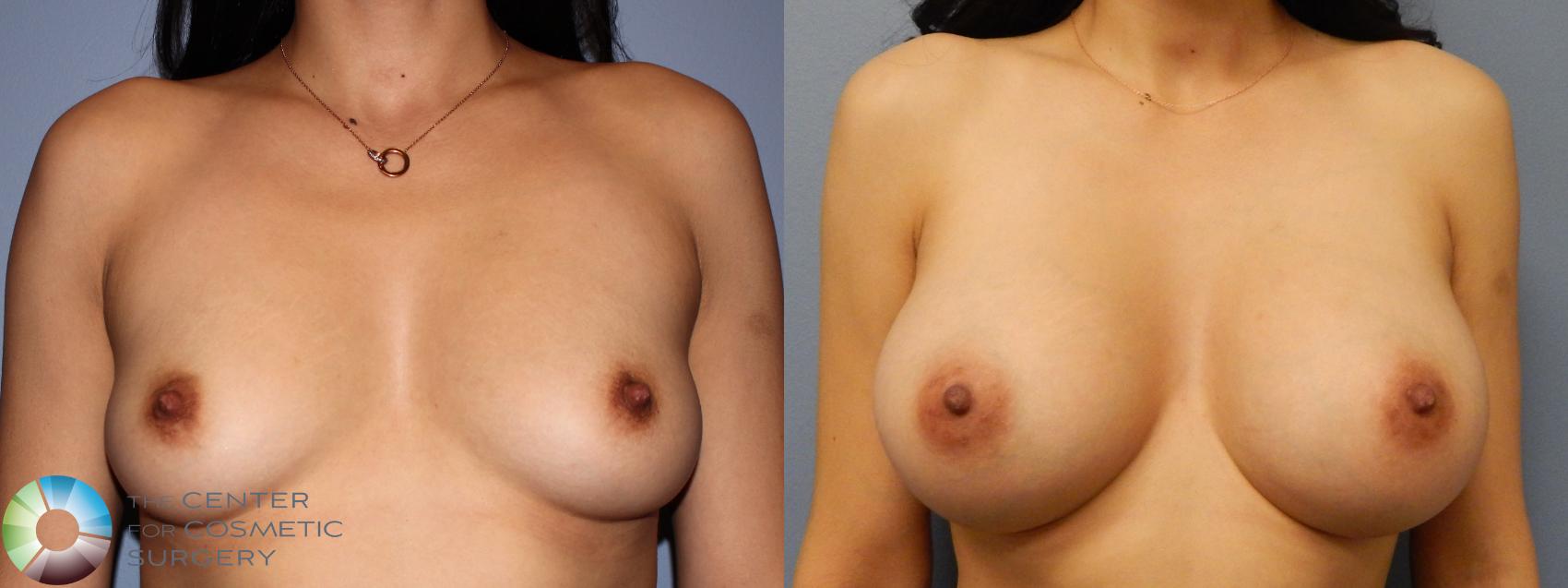 Before & After Breast Augmentation Case 981 Anterior in Denver and Colorado Springs, CO