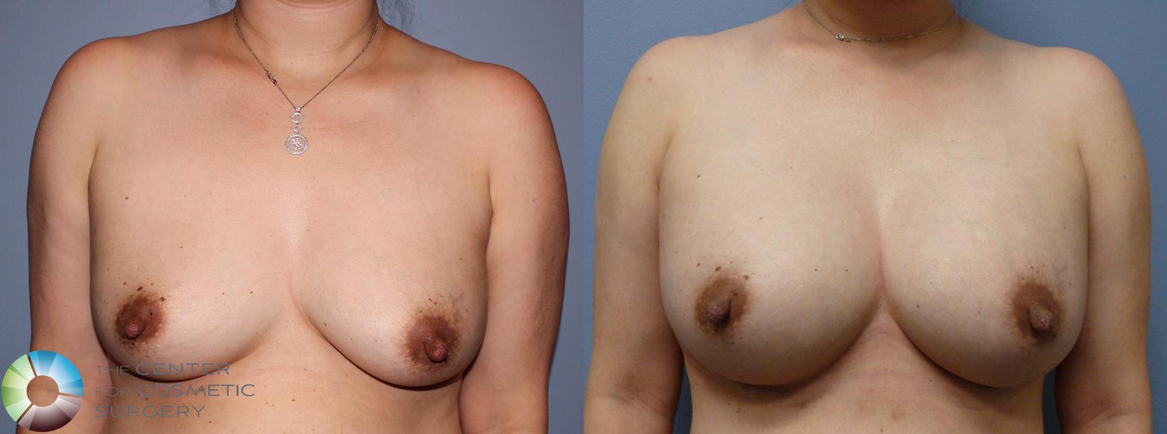 Before & After Breast Augmentation Case 982 View #1 in Denver and Colorado Springs, CO