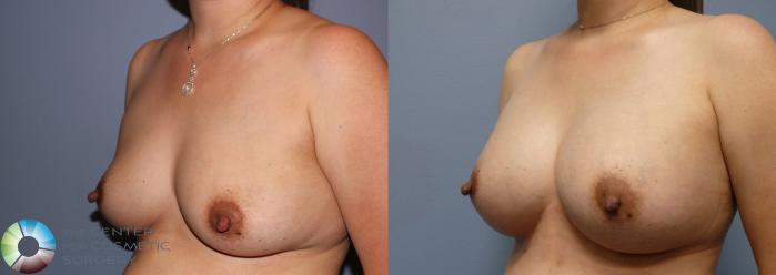 Before & After Breast Augmentation Case 982 View #2 View in Golden, CO
