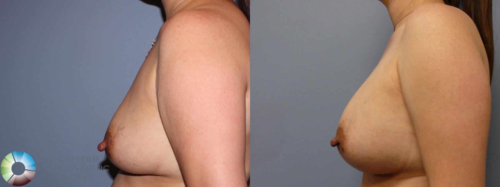 Before & After Breast Augmentation Case 982 View #3 View in Golden, CO