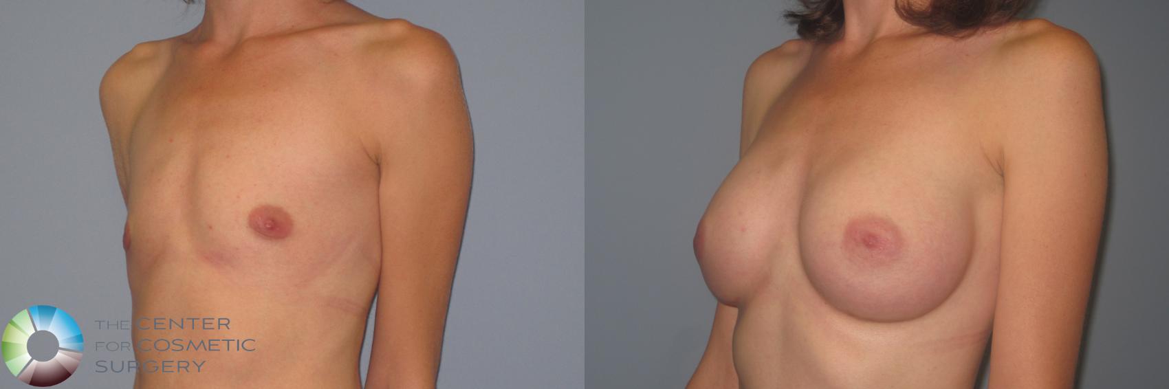 Before & After Breast Augmentation Case 984 View #1 in Denver, CO