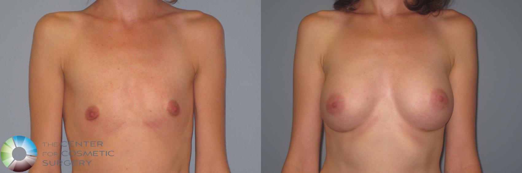 Before & After Breast Augmentation Case 984 View #2 in Denver and Colorado Springs, CO