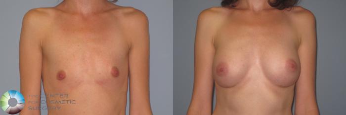Before & After Breast Augmentation Case 984 View #2 View in Golden, CO
