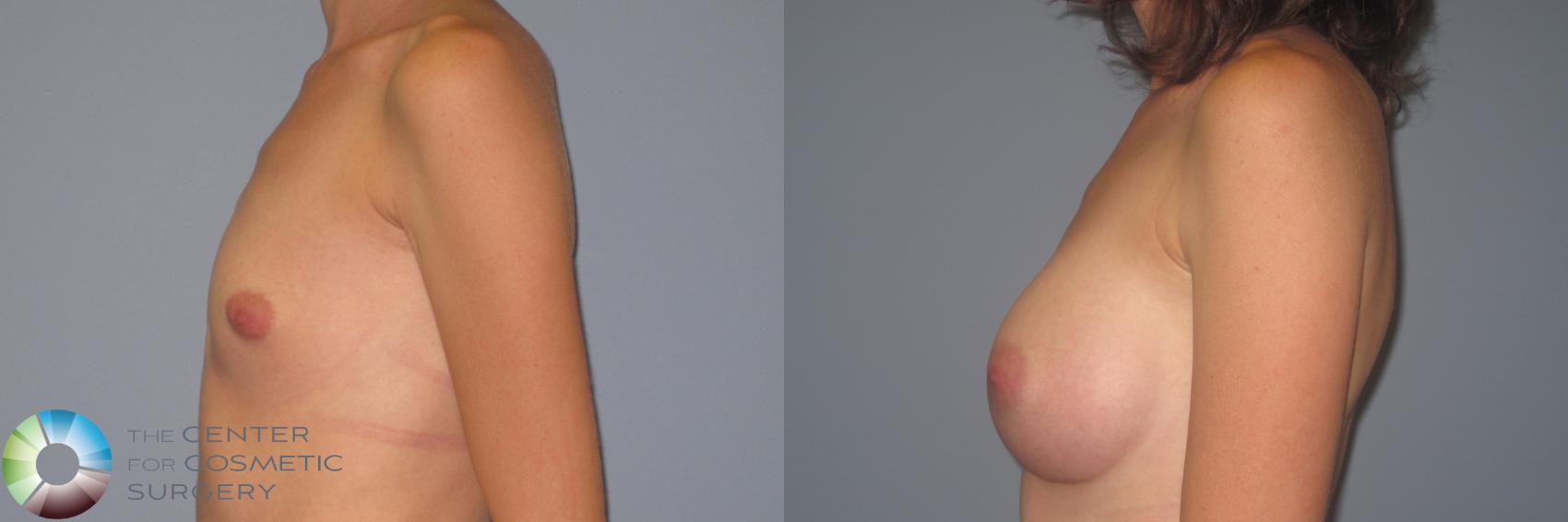 Before & After Breast Augmentation Case 984 View #3 in Denver and Colorado Springs, CO