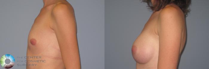 Before & After Breast Augmentation Case 984 View #3 View in Golden, CO