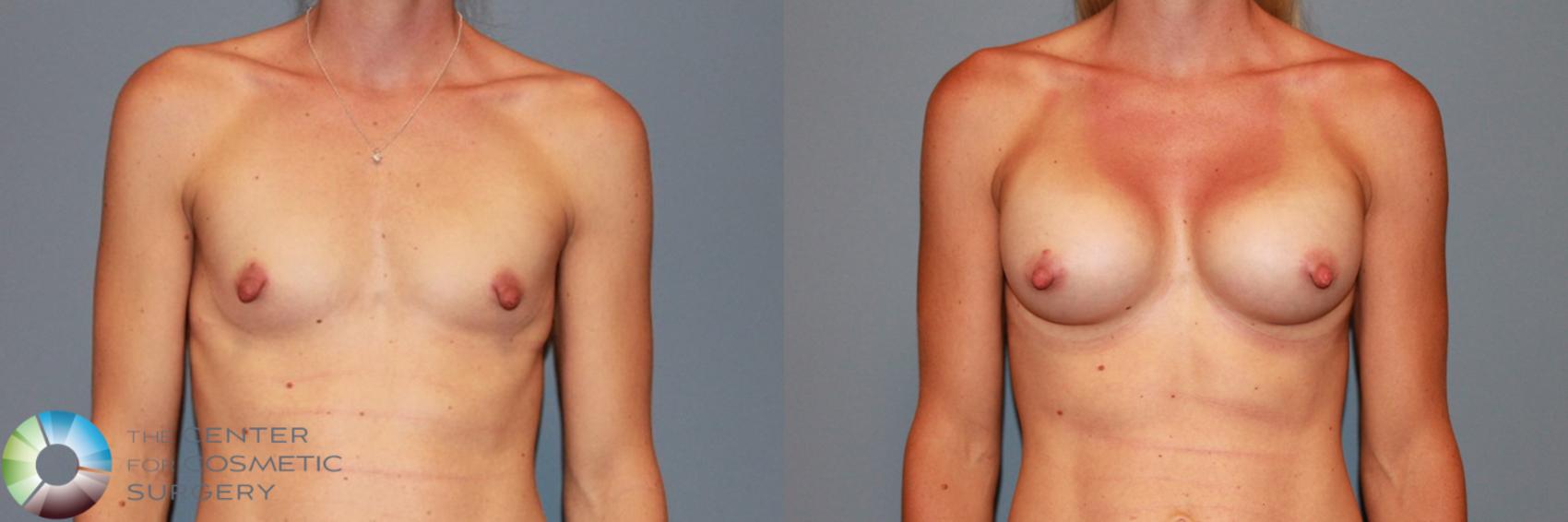 Before & After Breast Augmentation Case 985 View #1 in Denver and Colorado Springs, CO