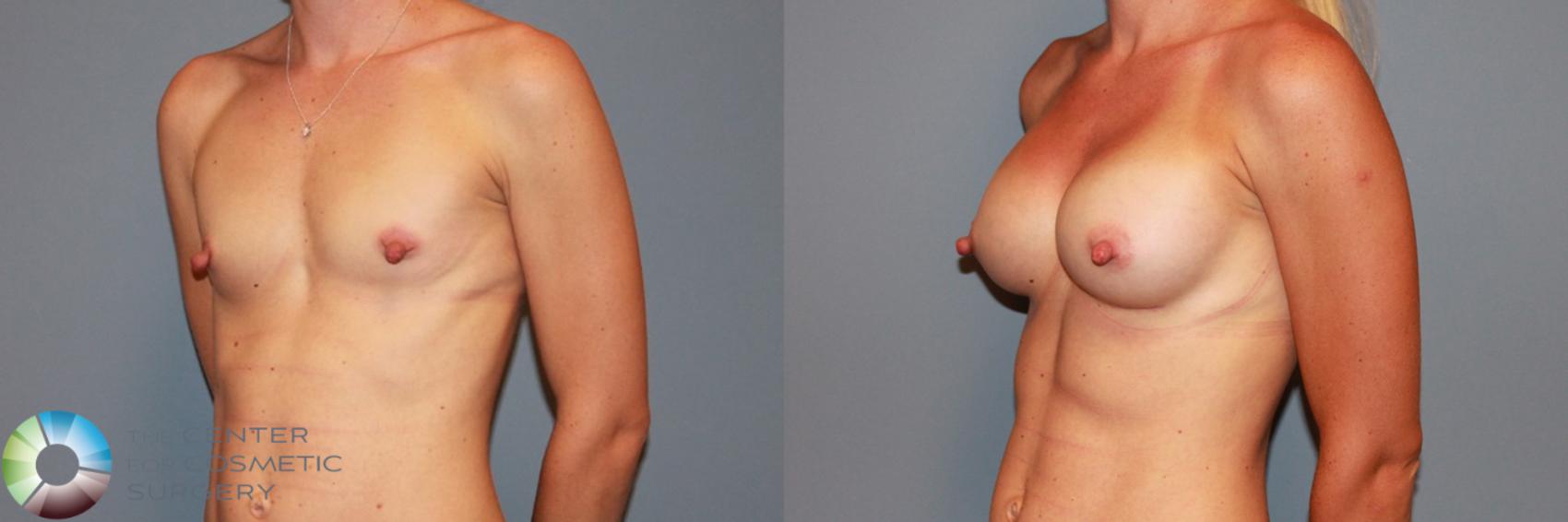 Before & After Breast Augmentation Case 985 View #2 in Denver and Colorado Springs, CO