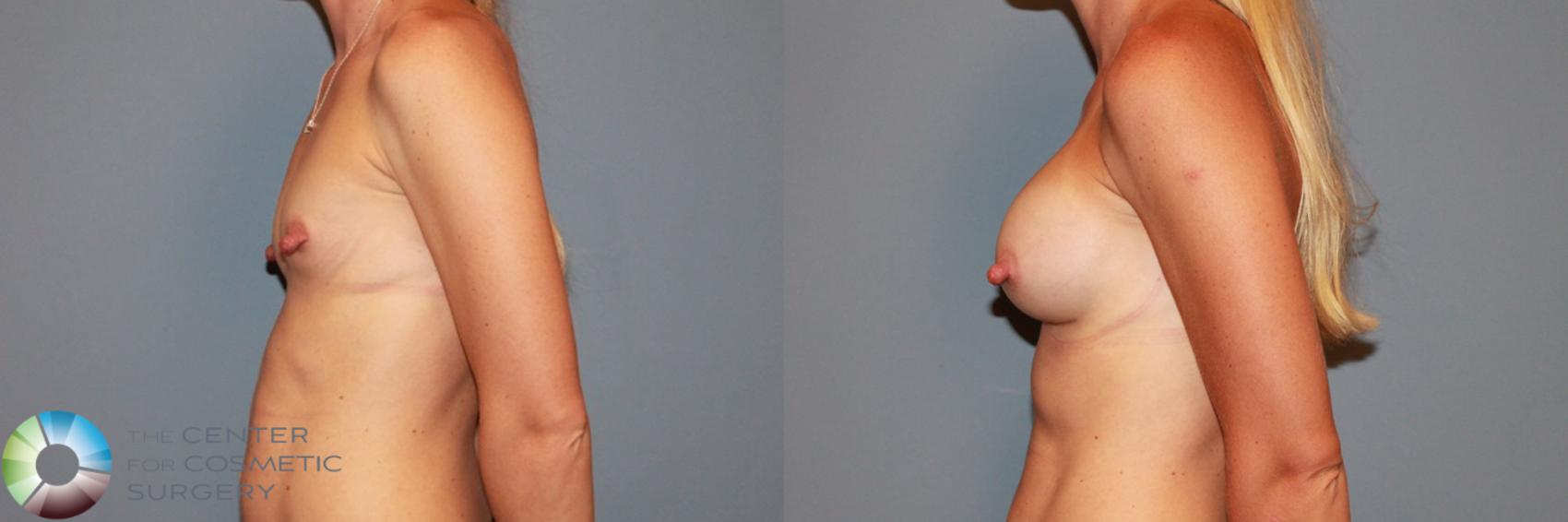 Before & After Breast Augmentation Case 985 View #3 in Denver and Colorado Springs, CO