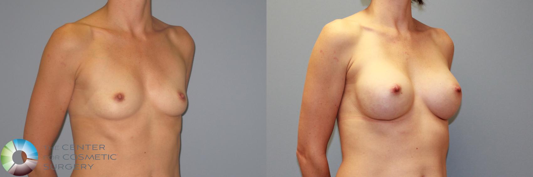 Before & After Breast Augmentation Case 986 View #1 View in Golden, CO