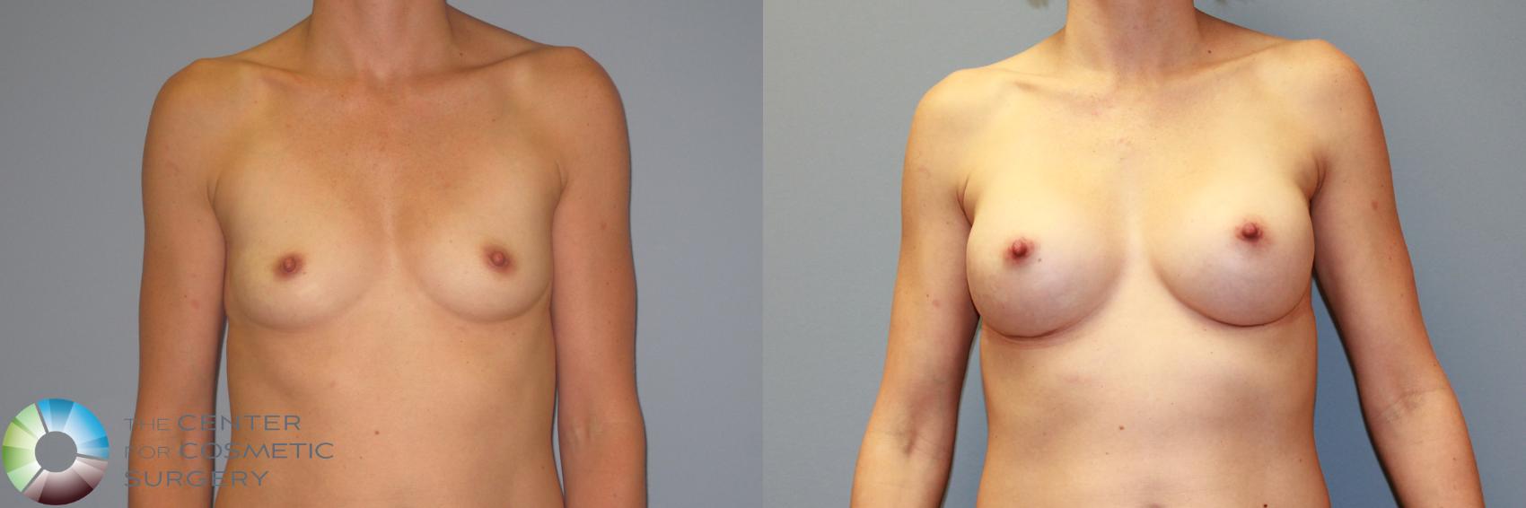 Before & After Breast Augmentation Case 986 View #2 in Denver and Colorado Springs, CO