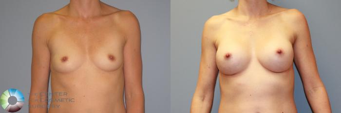 Before & After Breast Augmentation Case 986 View #2 View in Golden, CO