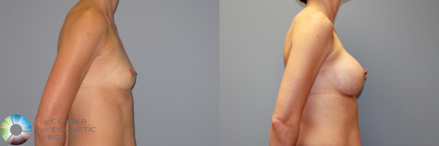 Before & After Breast Augmentation Case 986 View #3 in Denver and Colorado Springs, CO