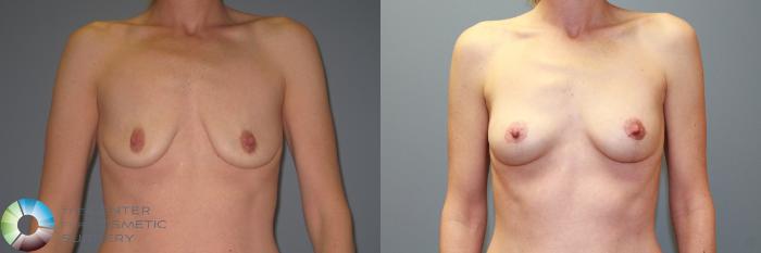 Before & After Breast Augmentation Case 987 View #1 in Denver and Colorado Springs, CO