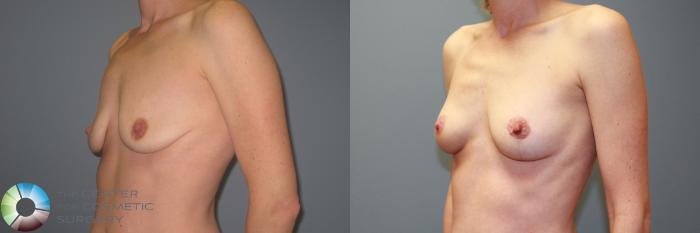 Before & After Breast Augmentation Case 987 View #2 in Denver and Colorado Springs, CO