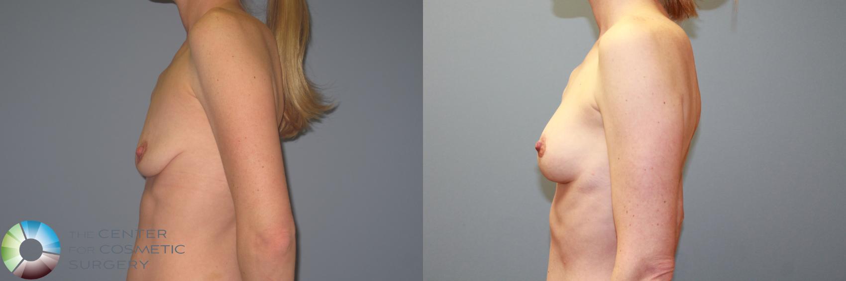 Before & After Breast Augmentation Case 987 View #3 in Denver and Colorado Springs, CO