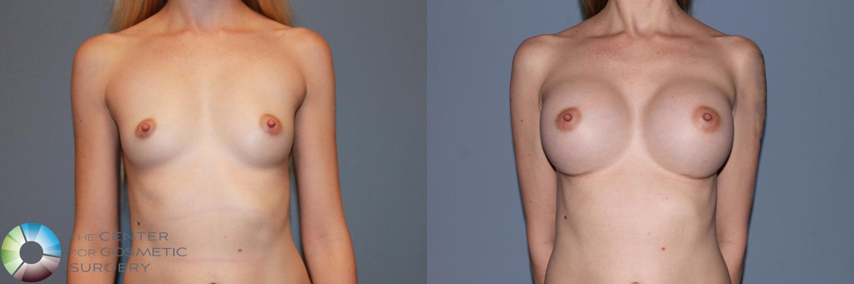 Before & After Breast Augmentation Case 988 View #1 in Denver and Colorado Springs, CO