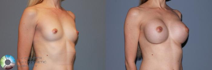 Before & After Breast Augmentation Case 988 View #2 View in Golden, CO