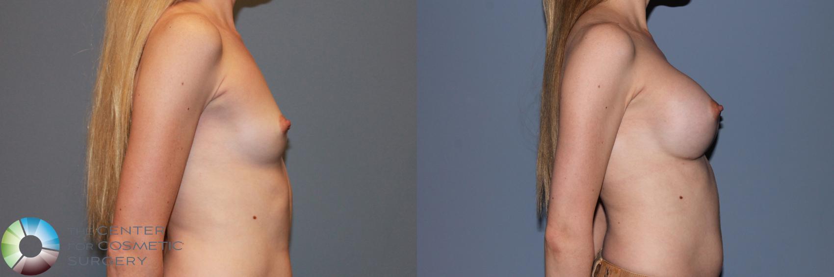 Before & After Breast Augmentation Case 988 View #3 View in Golden, CO