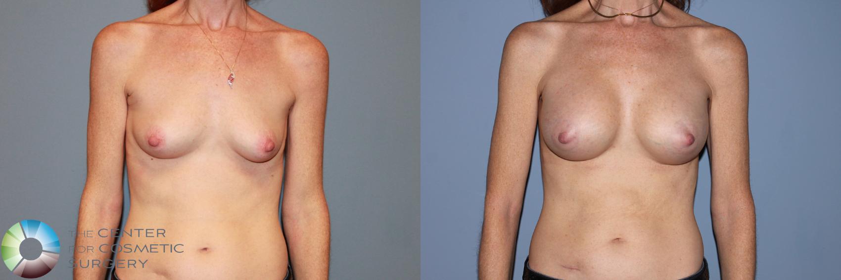 Before & After Breast Augmentation Case 995 View #1 in Denver and Colorado Springs, CO