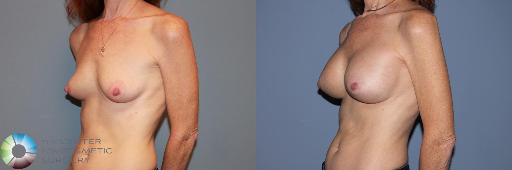 Before & After Breast Augmentation Case 995 View #2 in Denver and Colorado Springs, CO