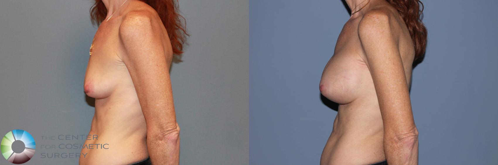 Before & After Breast Augmentation Case 995 View #3 in Denver and Colorado Springs, CO