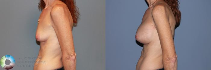 Before & After Breast Augmentation Case 995 View #3 View in Golden, CO