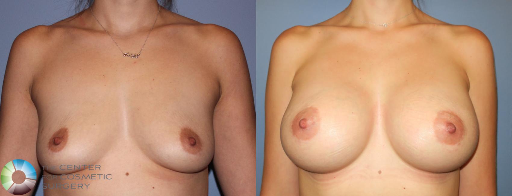 Before & After Breast Augmentation Case 996 View #1 in Denver and Colorado Springs, CO