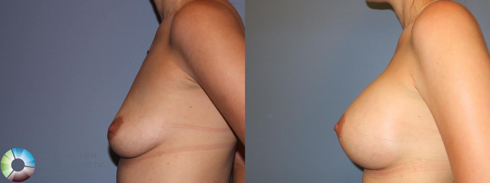 Before & After Breast Augmentation Case 996 View #2 in Denver and Colorado Springs, CO