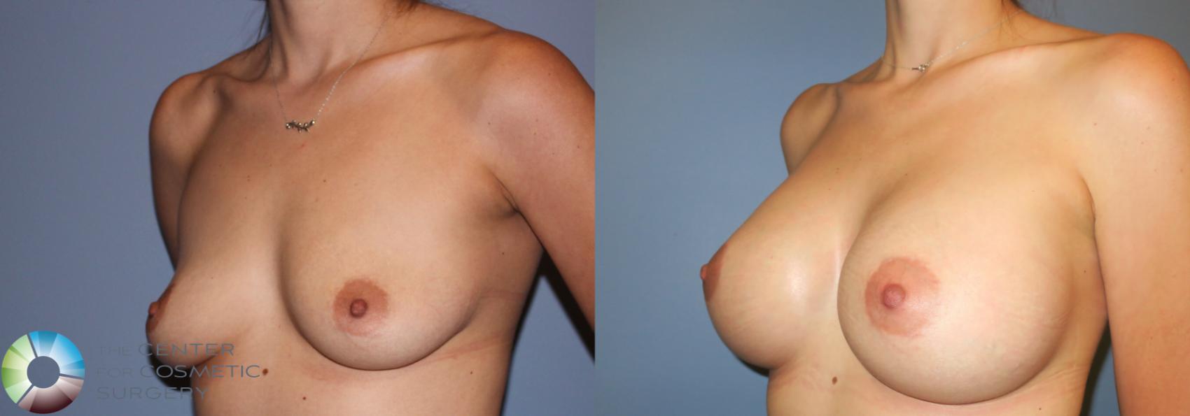 Before & After Breast Augmentation Case 996 View #3 in Denver and Colorado Springs, CO