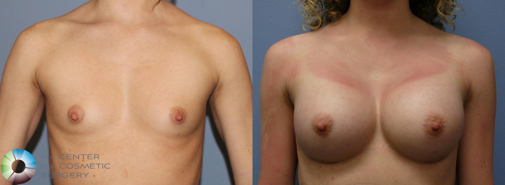 Before & After Breast Augmentation Case 999 View #1 View in Golden, CO