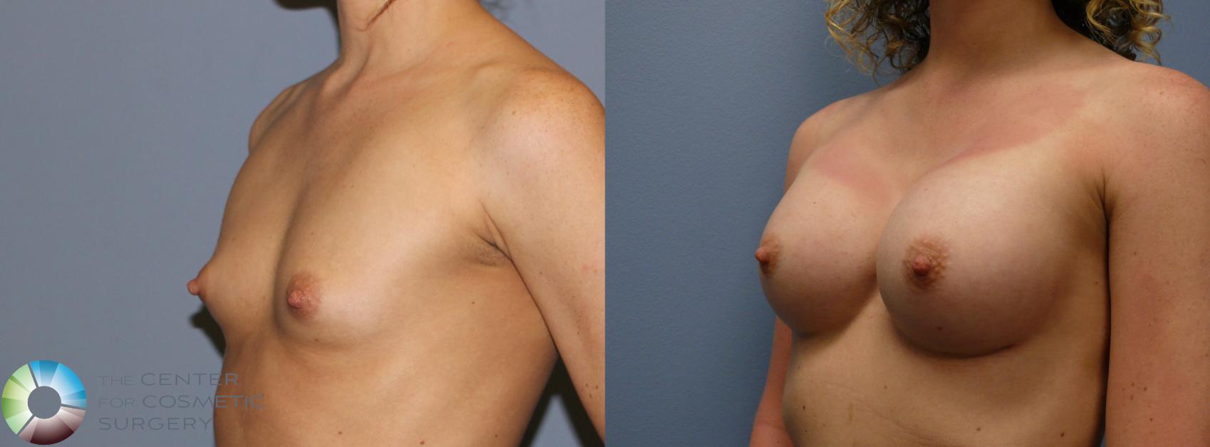 Before & After Breast Augmentation Case 999 View #2 in Denver and Colorado Springs, CO