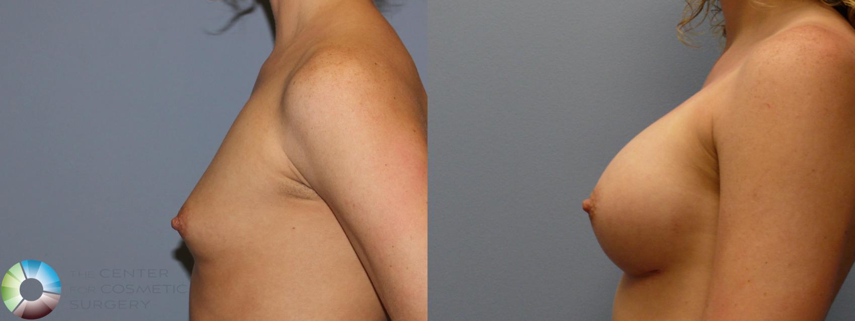 Before & After Breast Augmentation Case 999 View #3 in Denver and Colorado Springs, CO